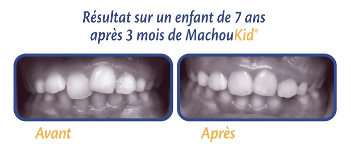 Machouyou - Masticateur première dentition